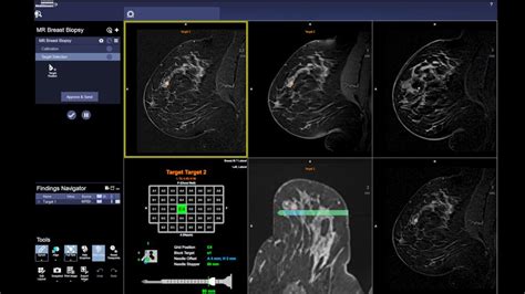 the villages breast imaging center|Breast Biopsy .